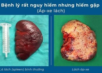 Áp-xe lách – bệnh lý rất nguy hiểm nhưng hiếm gặp đến mức bị…lãng quên