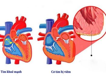 Nguyên nhân viêm cơ tim và các triệu chứng báo hiệu cần biết